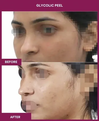 Female Glycolic Peel in Mumbai