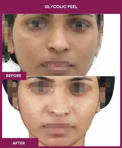 Female Glycolic Peel in Mumbai