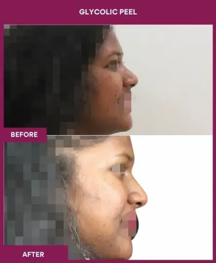 Glycolic Peel in Mumbai