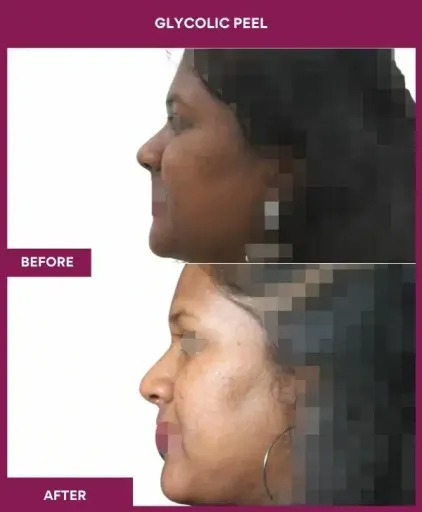 Glycolic Peel in Mumbai