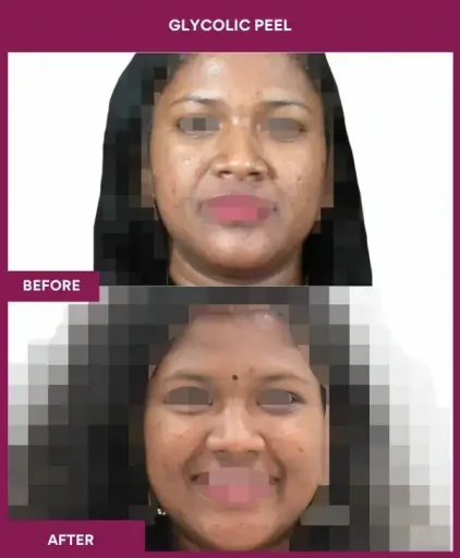 Glycolic Peel in Mumbai