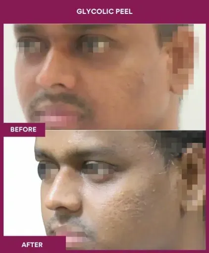 Glycolic Peel Before After Result