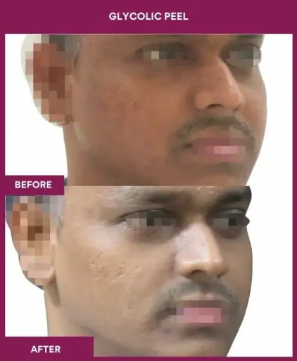 Glycolic Peel Before After Result