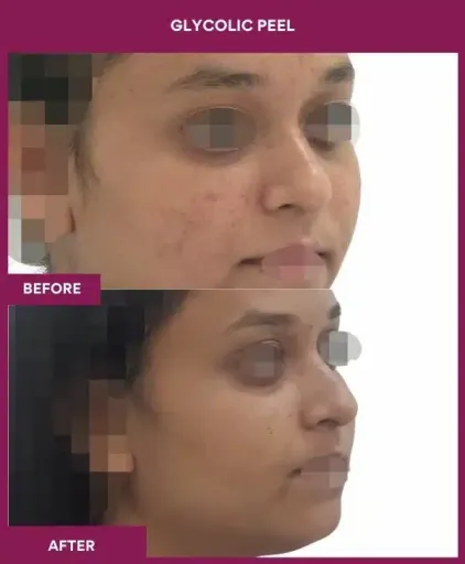 Glycolic Peel Before After Picture