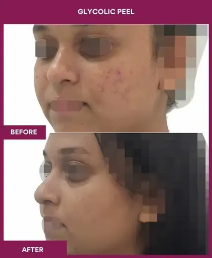 Glycolic Peel Before After Picture