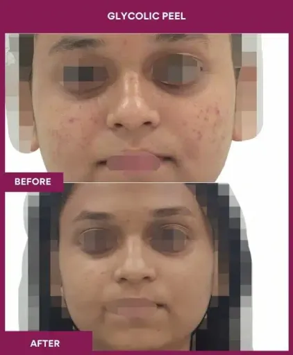 Glycolic Peel Before After Picture