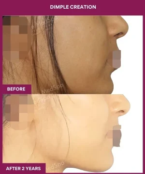 Female Dimple Creation surgery in Mumbai, India