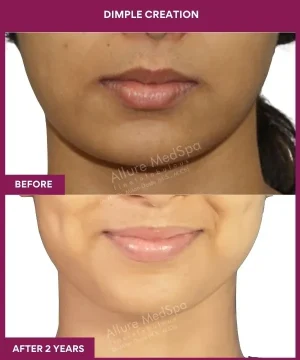 Female Dimple Creation surgery in Mumbai, India