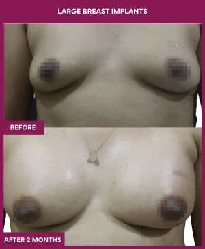 1 Large Breast Implants (4)_1