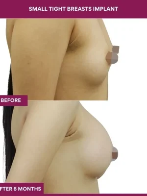 1 Small Tight Breasts Implant (3)_1