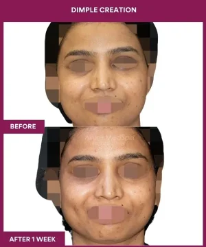 Dimple Creation Surgery in Mumbai, India