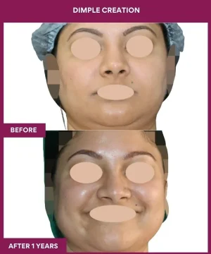 Dimple Creation Surgery in Mumbai, India