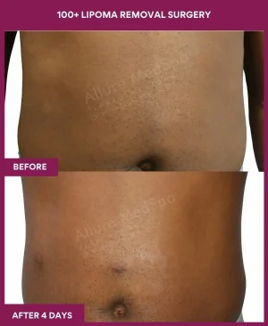 12 100+ Lipoma Removal Surgery