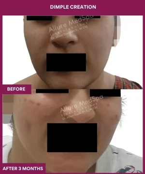 Dimple Creation Surgery in Mumbai, India