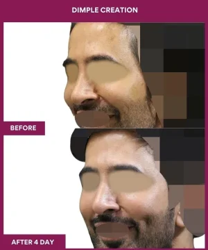 Male Dimpleplasty in mumbai, India