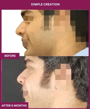 Male Dimple Creation in Mumbai, India