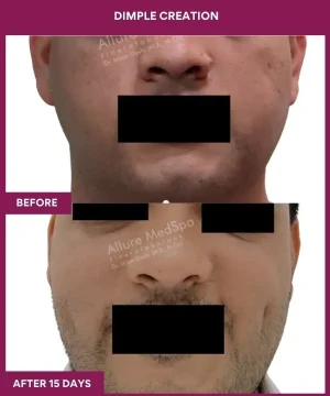 Dimple Creation Surgery in Mumbai, India