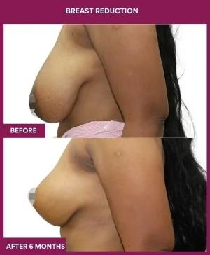 2-Breast Reduction_6_ (3)