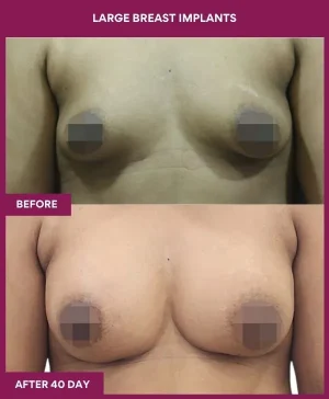 2 Large Breast Implants (4)_5_