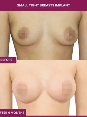 2 Small Tight Breasts Implant (4)_5_