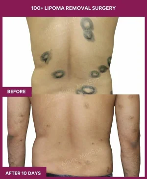 3 100+ Lipoma Removal Surgery