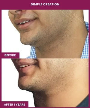 Male Dimple Creation Surgery in Mumbai, India