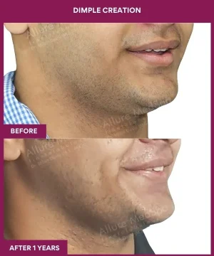 Male Dimple Creation Surgery in Mumbai, India