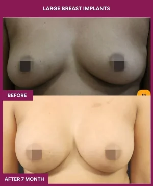 4 Large Breast Implants_12_ (1)