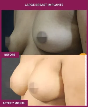 4 Large Breast Implants_12_ (3)