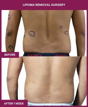 4 Lipoma Removal Surgery (2)