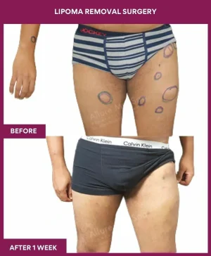 4 Lipoma Removal Surgery