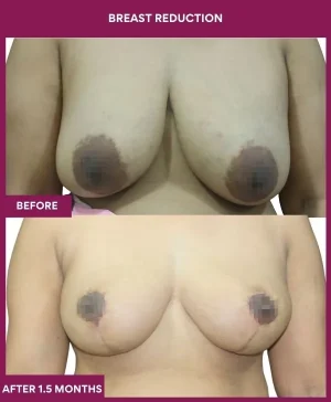 5 BREAST REDUCTION (4)_1_