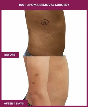 7 100+ Lipoma Removal Surgery (2)