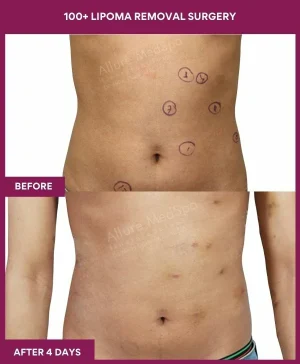 7 100+ Lipoma Removal Surgery