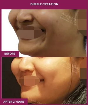 Female Dimpleplasty in Mumbai, India